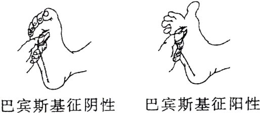 巴宾斯基征阳性巴宾斯基征阴性