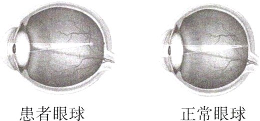 患者眼球正常眼球