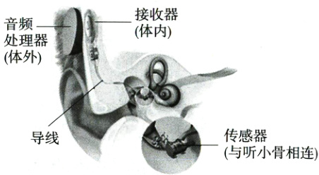 传感器导线与听小骨相连
