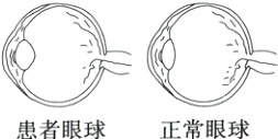 正常眼球患者眼球